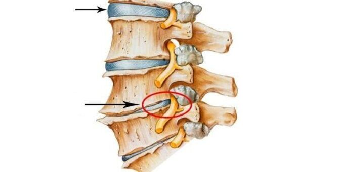 Cervical Osteochondrosis Healthy and Damaged Discs