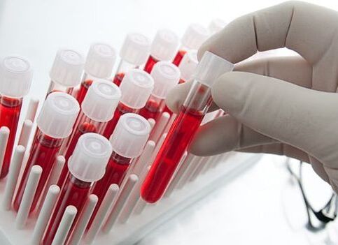 Blood tests to diagnose arthritis and joint disease