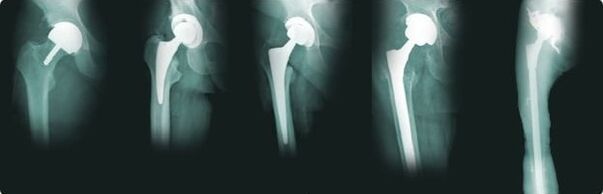 Joint replacement hip options