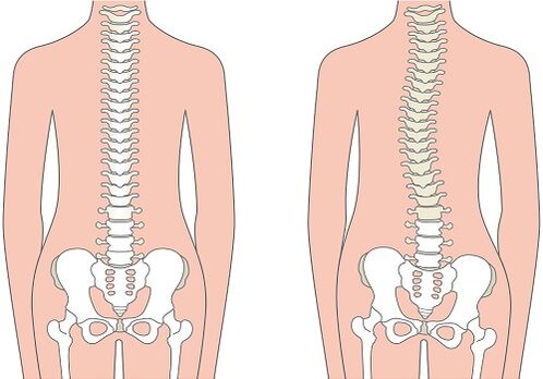 Low back pain due to spinal deformity (such as scoliosis)