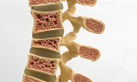 Osteoporosis is a cause of low back pain