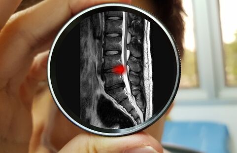 The consequence of ignoring lower back pain may be a herniated disc. 