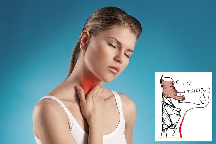 Osteocartilage in cervical vertebrae compresses nerves, causing sore throat