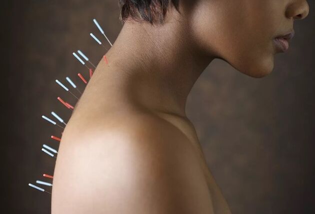 acupuncture