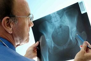 Hip arthritis on X-rays