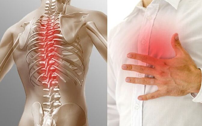 Chest osteochondrosis and chest pain