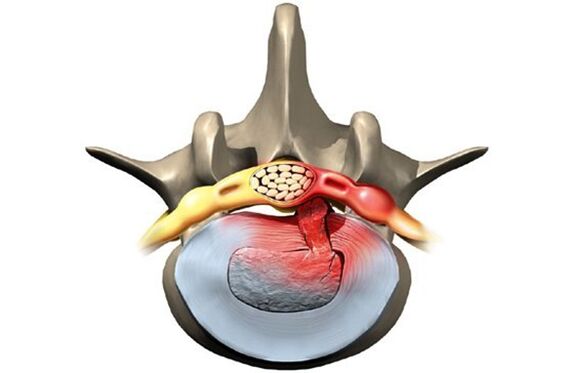 Vertebrae affected by osteochondrosis